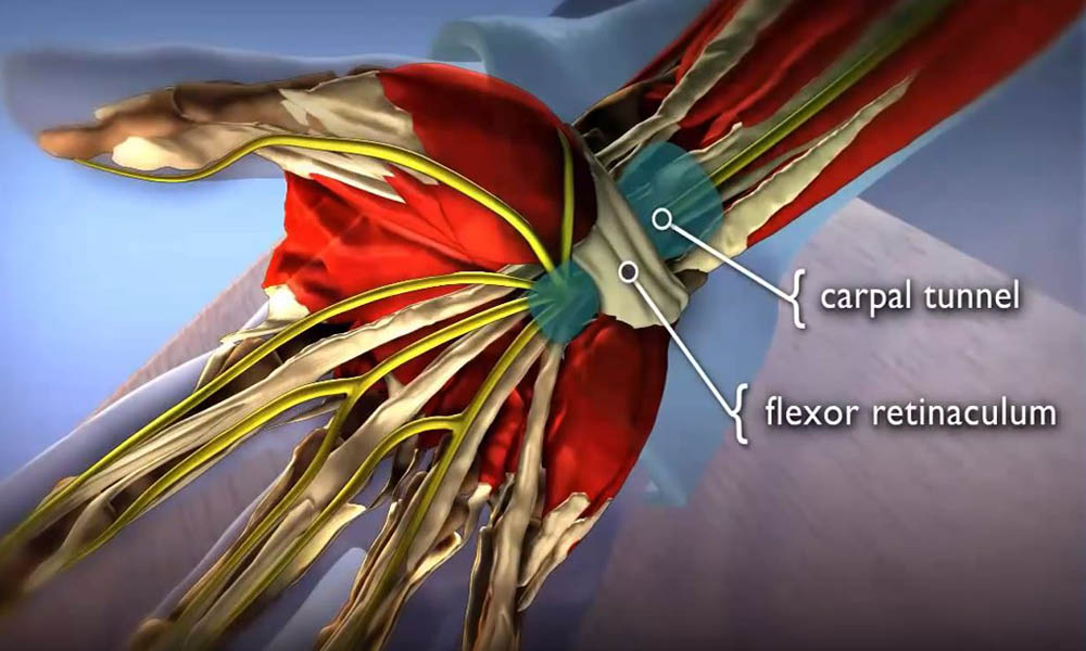 Carpal Tunnel Syndrome Carpal Tunnel Syndrome